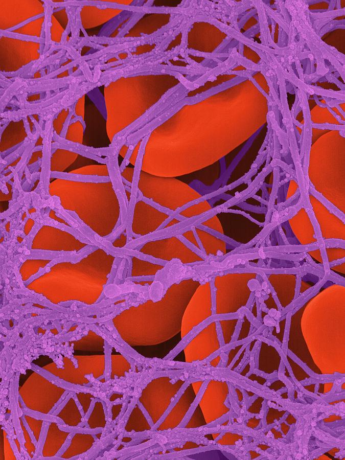 Medical Photograph - Blood Clot #5 by Dennis Kunkel Microscopy/science Photo Library