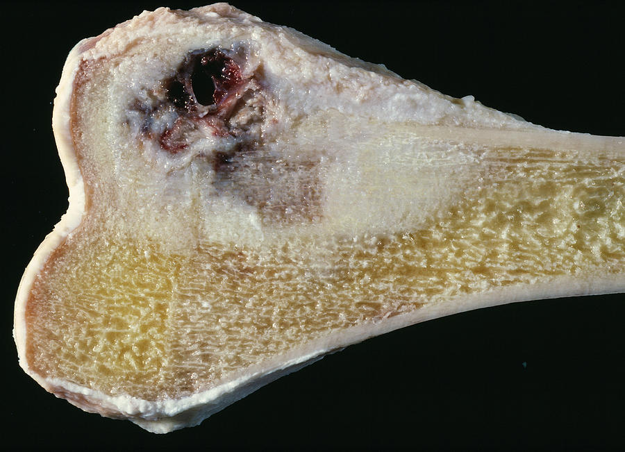 Osteosarcoma Photograph - Bone Cancer by Cnri/science Photo Library