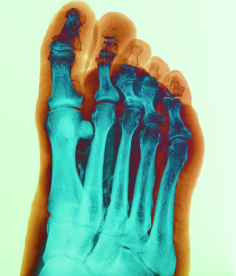 Bone Infection #5 Photograph by Zephyr/science Photo Library