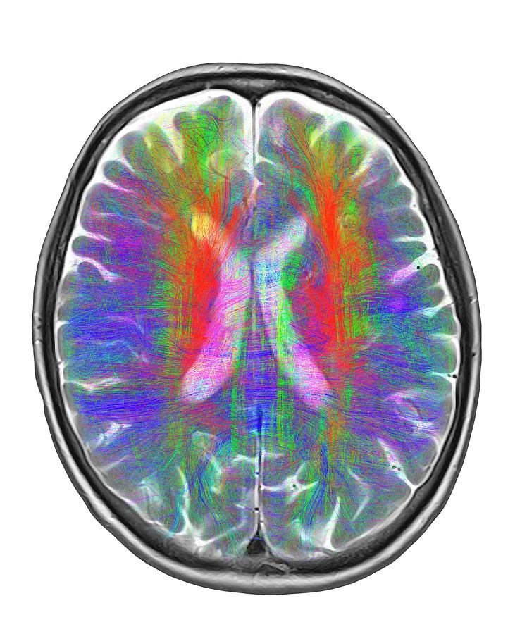 Brain Mri And White Matter Fibres #5 Photograph by Alfred Pasieka/science Photo Library