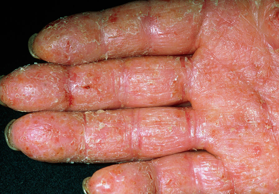 Contact Dermatitis Photograph By Dr P Marazzi Science Photo Library