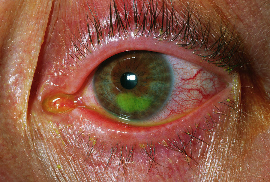 Corneal Abrasion Photograph by Dr P. Marazzi/science Photo Library