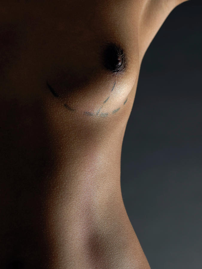 Cosmetic Surgery #5 Photograph by Kate Jacobs/science Photo Library