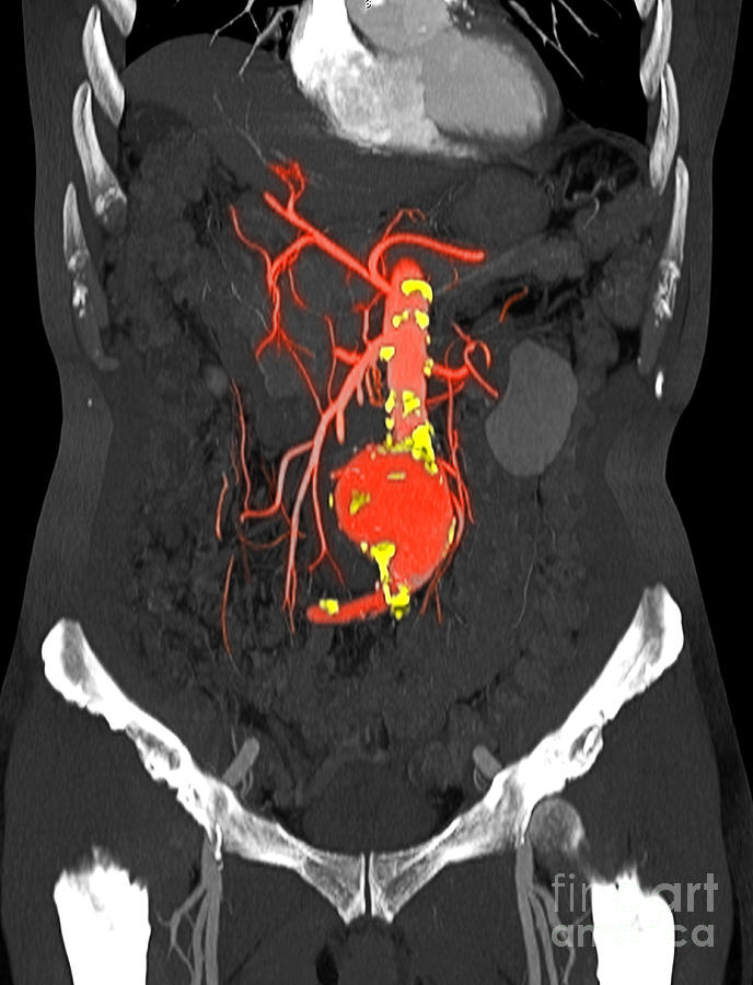Ct Scan Of Abdominal Aortic Aneurysm #5 Photograph by Scott Camazine