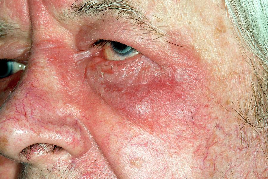 Eczema Around The Eye Photograph By Dr P Marazzi Science Photo Library