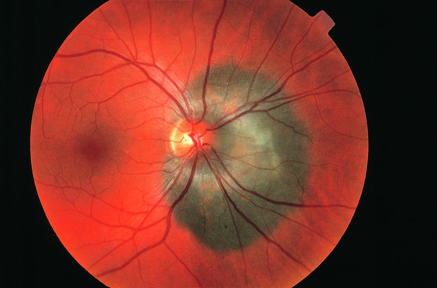 Cancer Photograph - Eye Cancer #5 by Sue Ford/science Photo Library