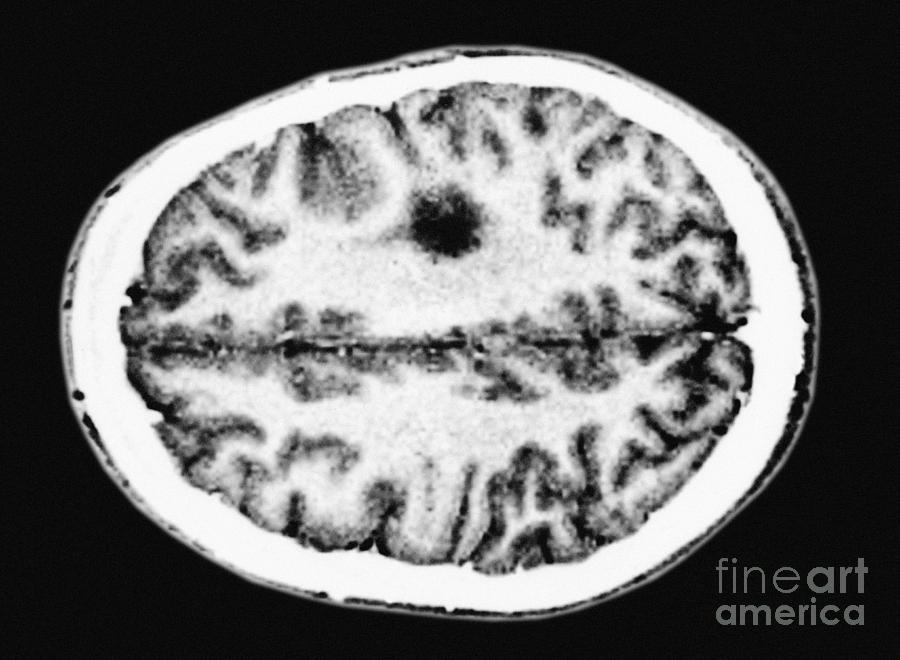 Glioma Brain Tumor #5 Photograph by Scott Camazine