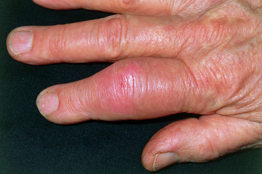 Gout Photograph By Dr P Marazzi Science Photo Library