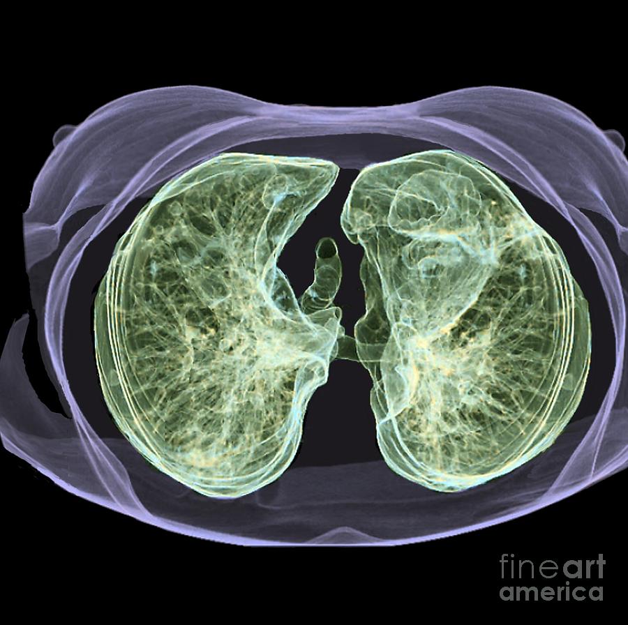 Healthy Lungs 3d Ct Scan Photograph By Zephyr Fine Art America