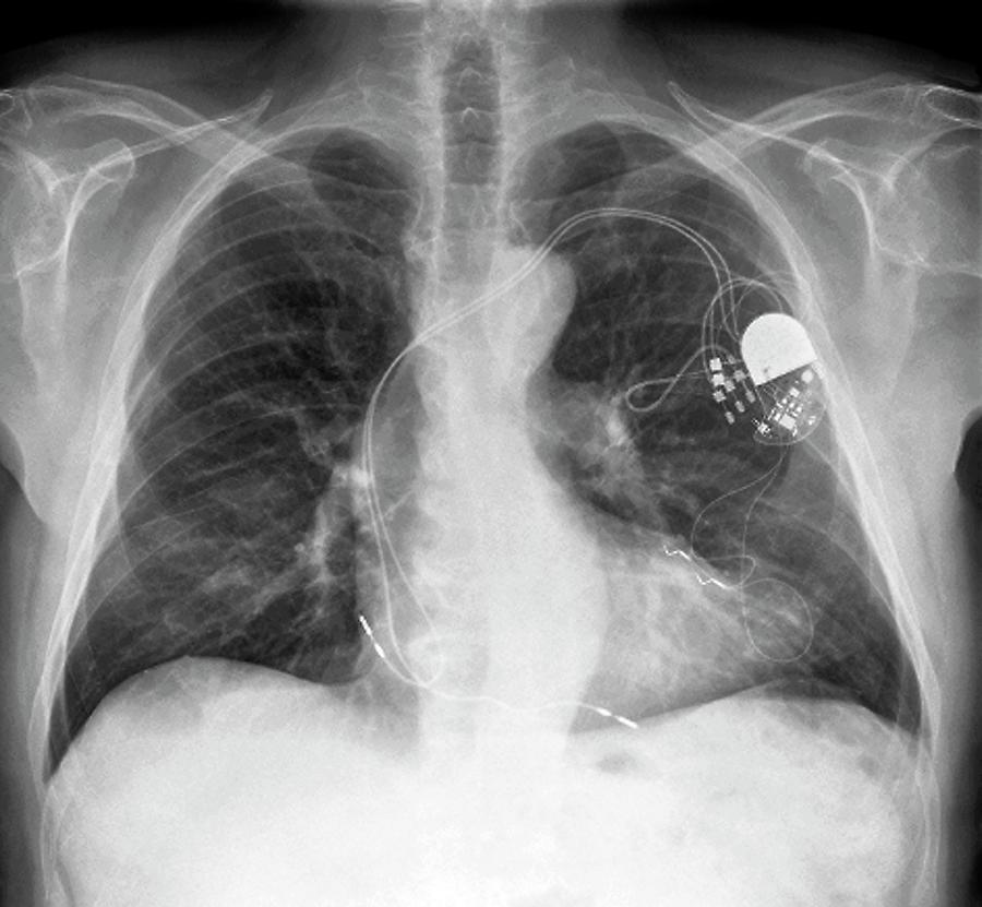 Heart Pacemaker Photograph by Zephyr/science Photo Library - Fine Art ...