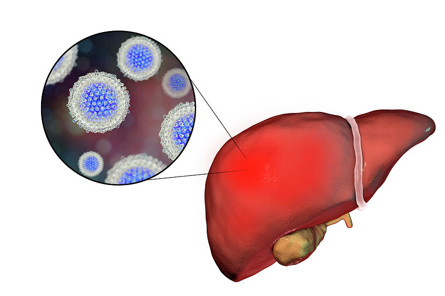 Печень гепатит картинка