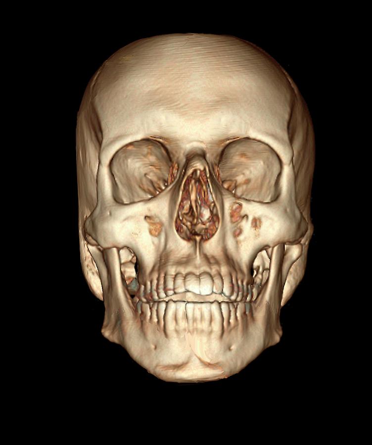 Human Skull Photograph By Zephyr Science Photo Library