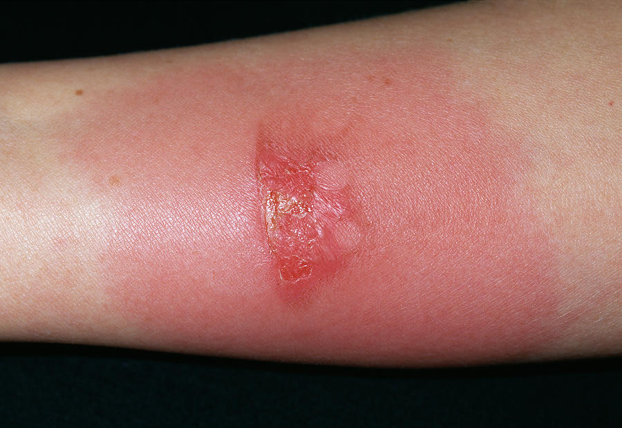 Infected Burn Photograph By Dr P Marazzi science Photo Library