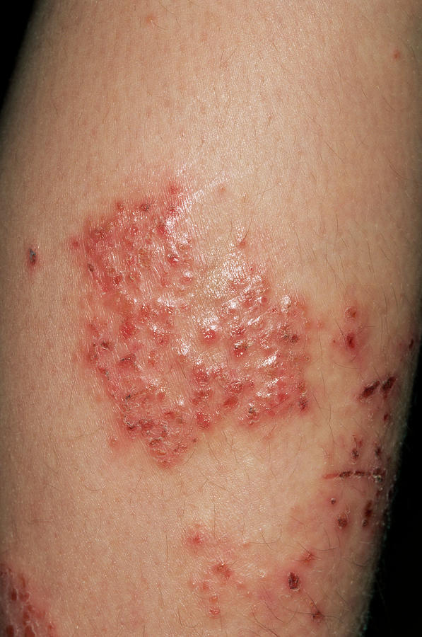 Infected Eczema Photograph By Dr P Marazzi Science Photo Library