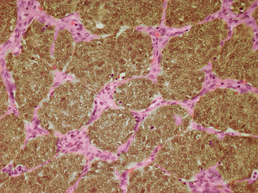 Kidney Cancer #5 Photograph by Steve Gschmeissner