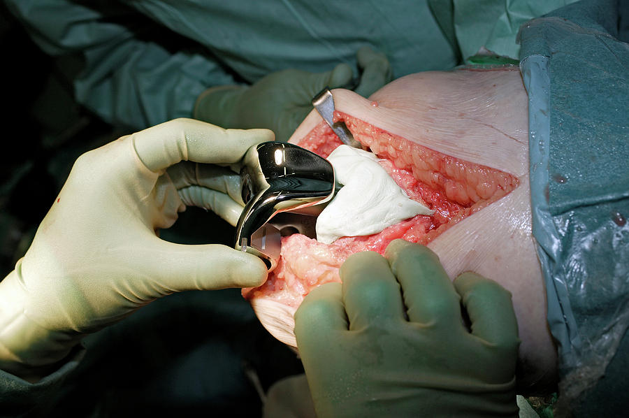 Knee Replacement Surgery Photograph by Antonia Reeve/science Photo