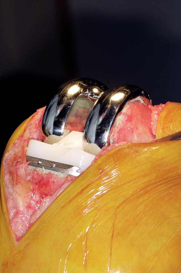 Knee Replacement Surgery Photograph by Dr P. Marazzi