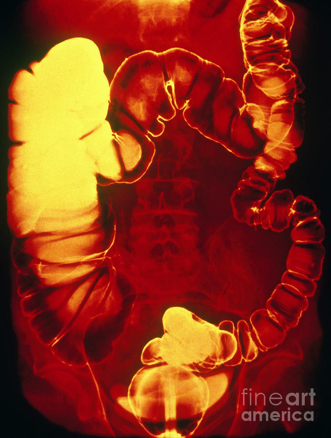 Medical Photograph - Large And Small Intestine, Barium X-ray #5 by Scott Camazine