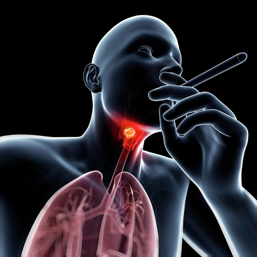 Pathophysiology Of Laryngeal Cancer 8078