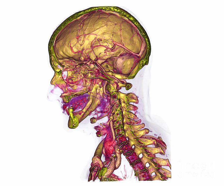 Male Skull & Arterial System #5 Photograph by Scott Camazine