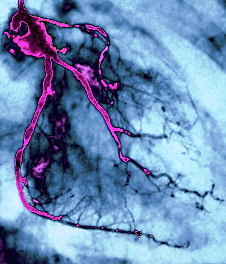 Narrowed Coronary Arteries #5 Photograph by Zephyr/science Photo Library