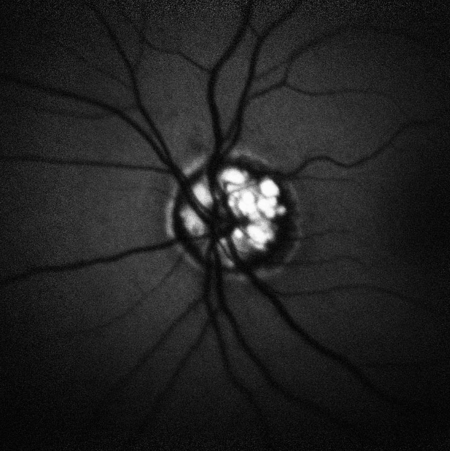 Optic Nerve Head Druzen #5 Photograph by Paul Whitten