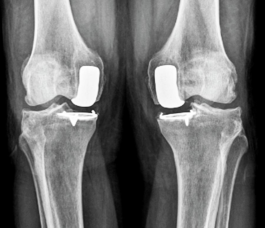 Partial Knee Replacement Photograph by Zephyr - Fine Art America