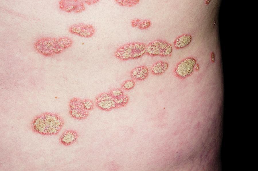 Red Photograph - Plaque Psoriasis On The Skin by Dr P. Marazzi/science Photo Library Red Photograph - Plaque Psoriasis On The Skin by Dr P. Marazzi/science Photo Library