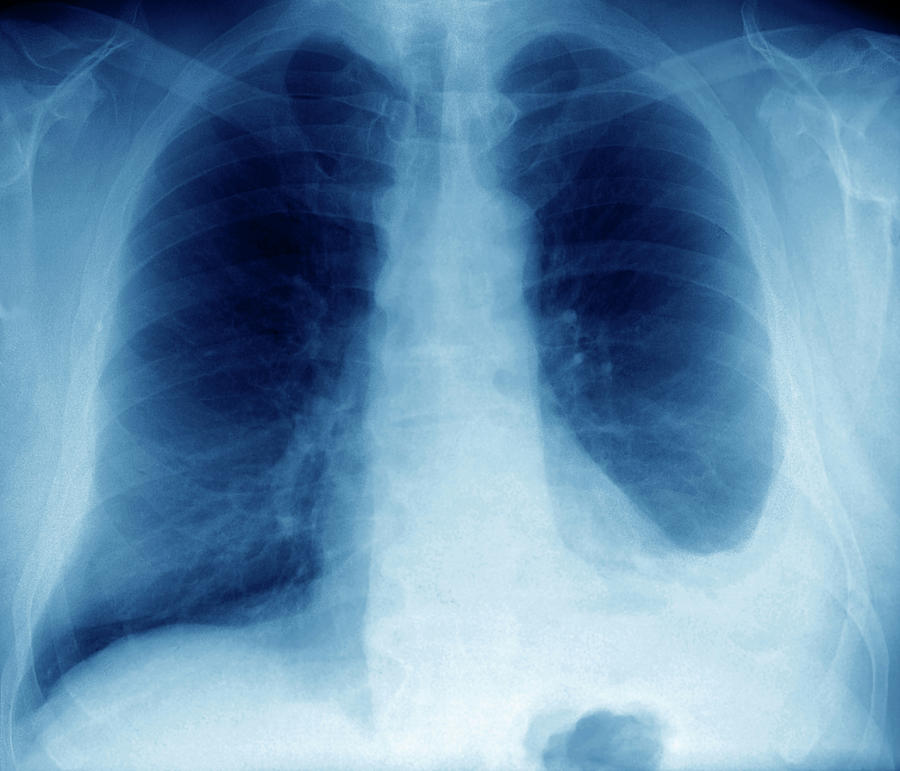 pleural fluid