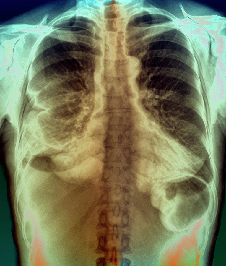 Pleurisy #5 Photograph by Zephyr/science Photo Library