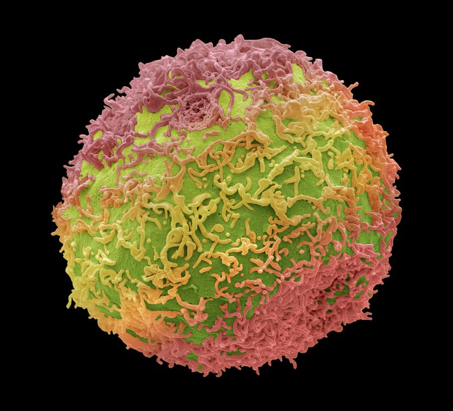 Prostate Cancer Cell Photograph By Steve Gschmeissner Pixels 2206