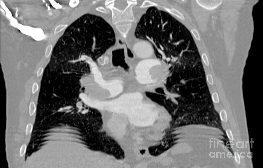 Pulmonary Embolism Photograph - Pulmonary Embolism, Ct Scan #5 by Du Cane Medical Imaging Ltd