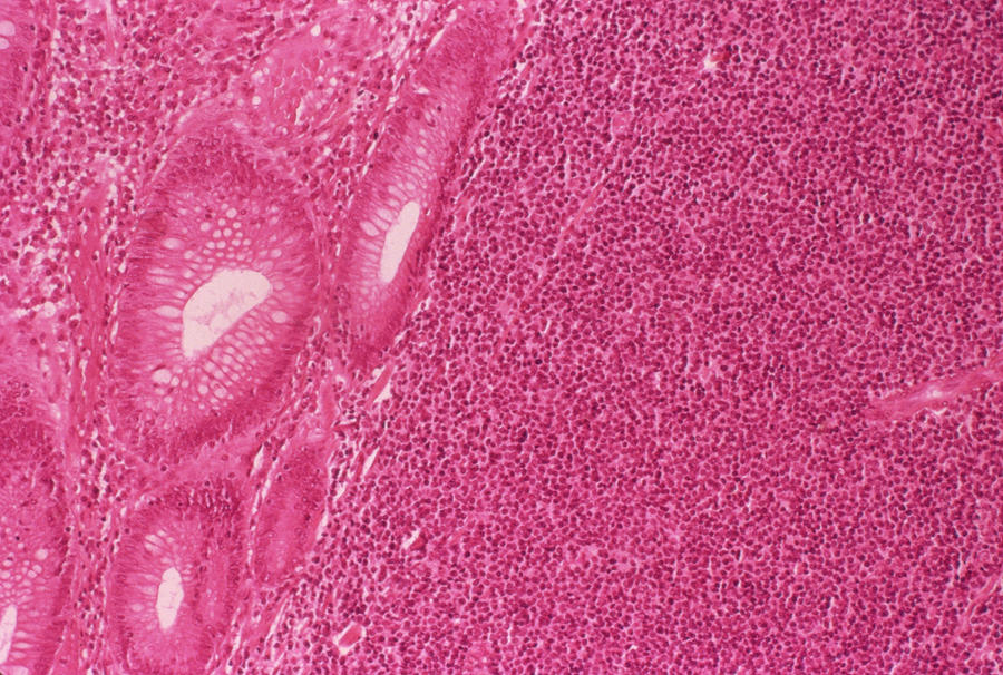 Rectal Cancer #5 by Cnri/science Photo Library