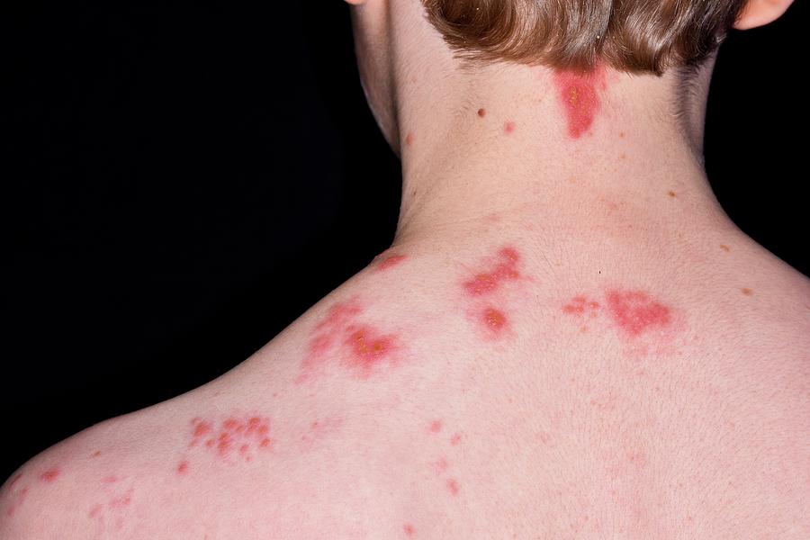 Shingles Rash Photograph by Dr P. Marazzi/science Photo Library