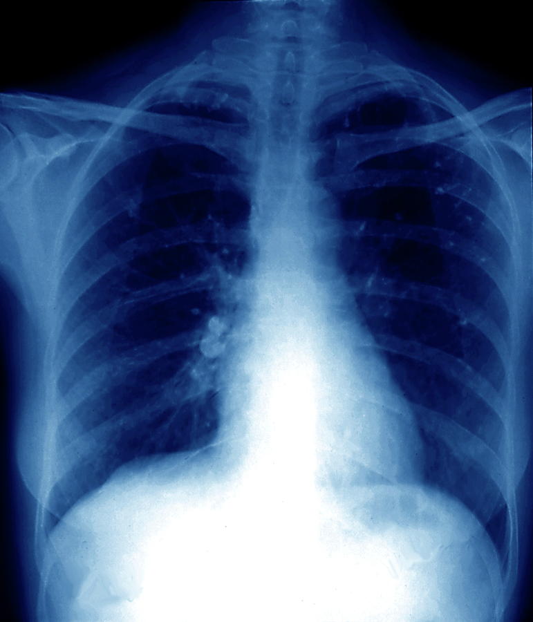 Tuberculosis Photograph by Zephyr/science Photo Library - Fine Art America