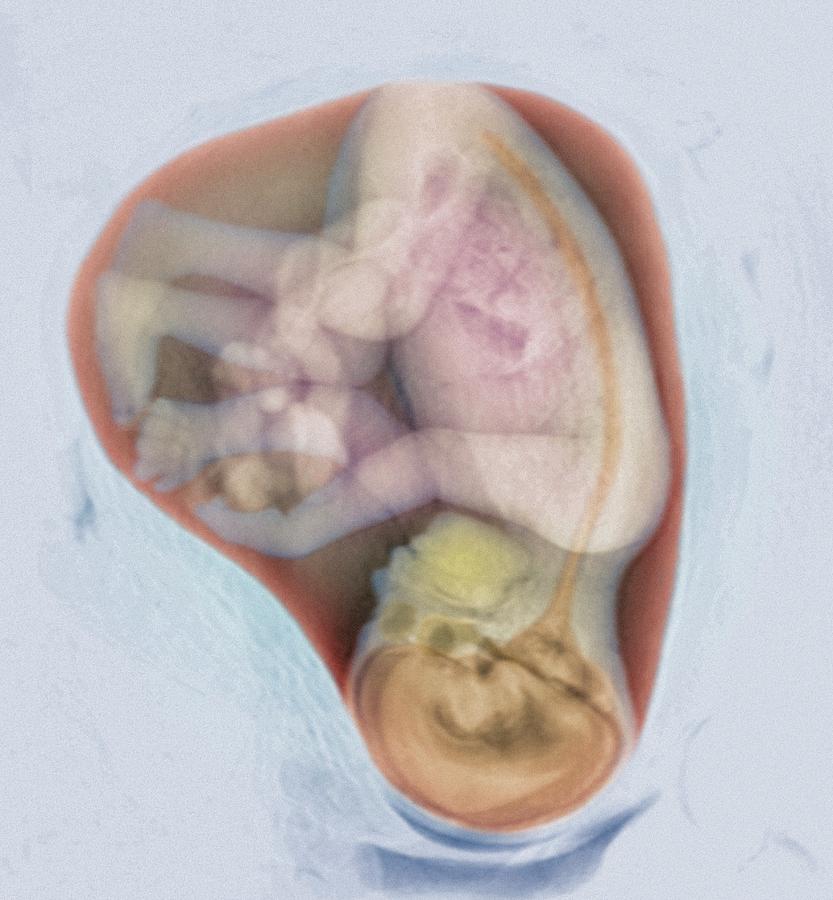 3-d Photograph - 27 Week Foetus #6 by Simon Fraser/royal Victoria Infirmary, Newcastle Upon Tyne/science Photo Library