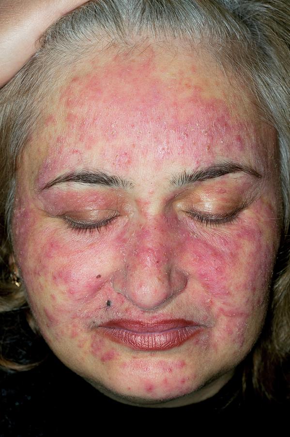 Acne Rosacea On The Face Photograph By Dr Harout Tanielianscience