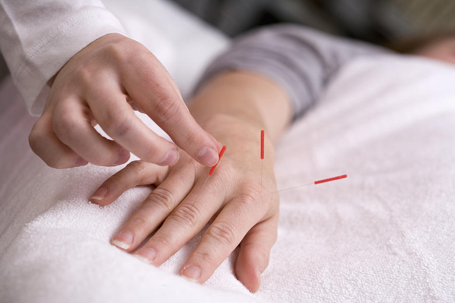 Acupuncture Photograph By Science Stock Photography