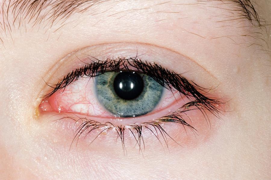 Allergic Conjunctivitis Photograph By Dr P Marazziscience Photo Library 