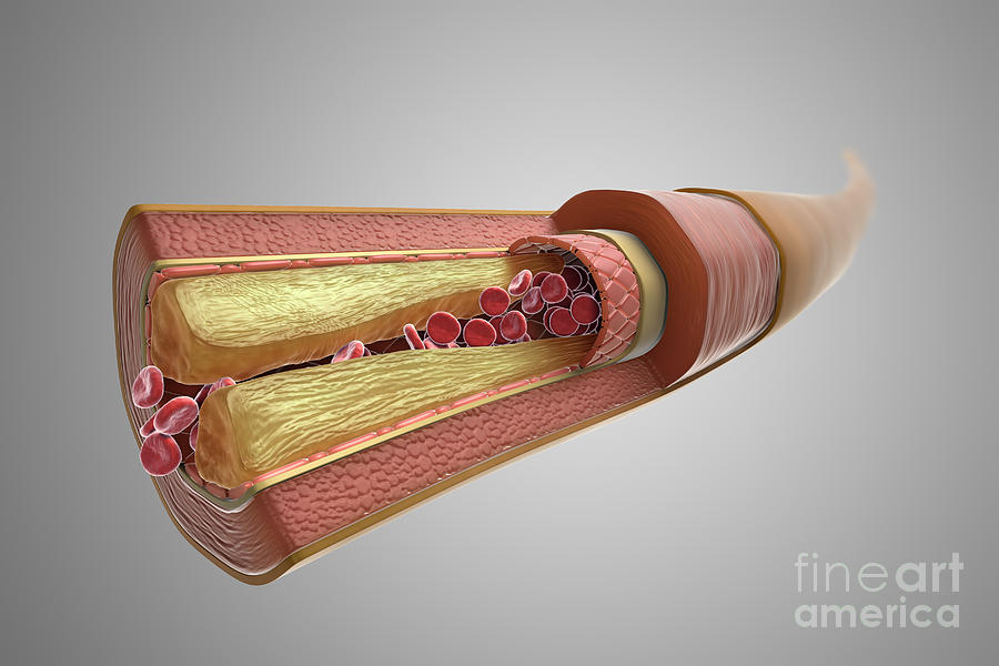 Atherosclerosis #6 Photograph by Science Picture Co