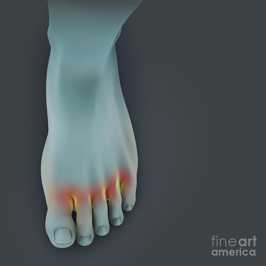 Athletes Foot #6 Photograph by Science Picture Co