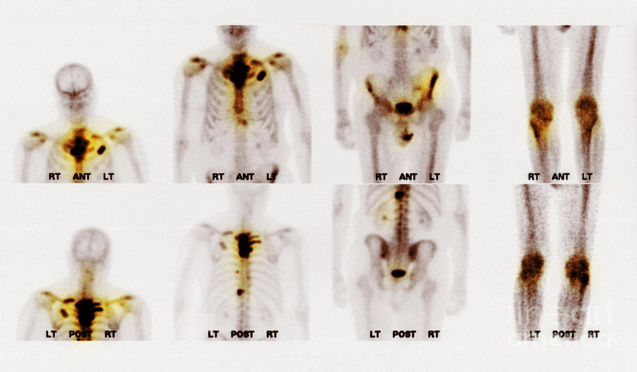 bone-scan-showing-multiple-metastases-photograph-by-scott-camazine-pixels