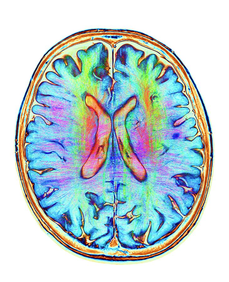Brain Mri And White Matter Fibres #6 Photograph by Alfred Pasieka/science Photo Library