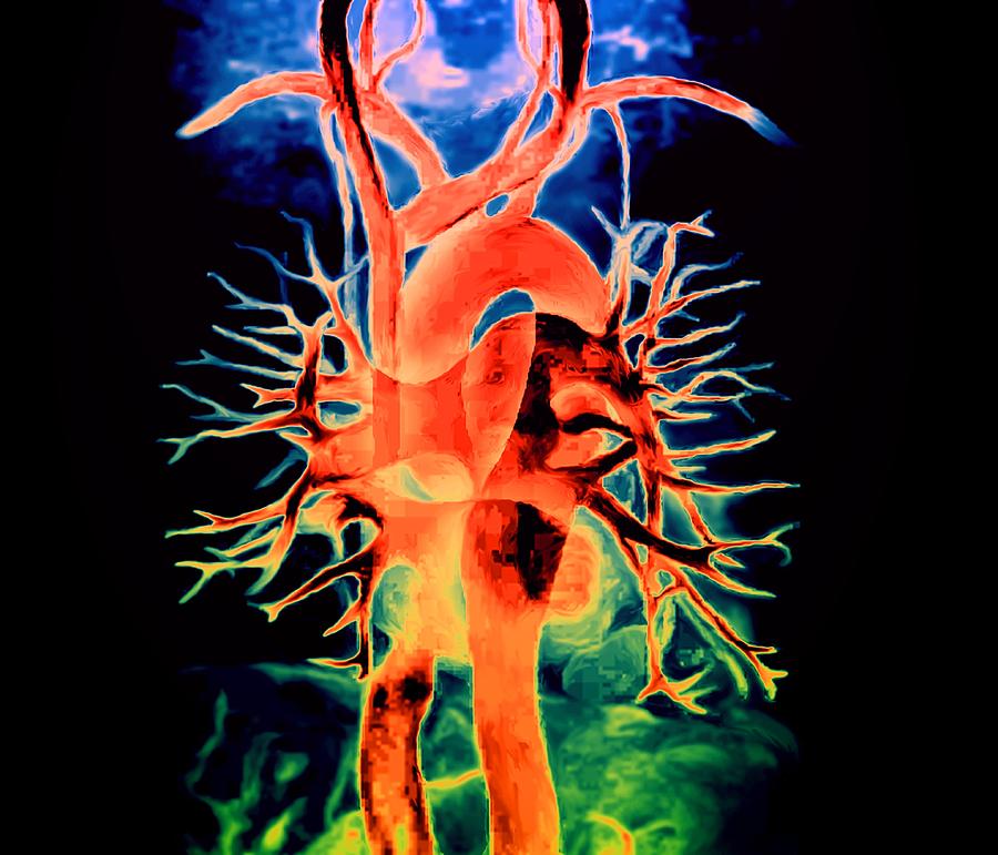 Chest Blood Vessels #6 Photograph by Zephyr/science Photo Library