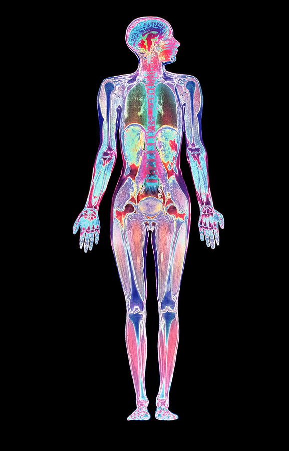 Coloured Mri Scan Of A Whole Human Body (female) #6 Photograph by Simon Fraser/science Photo Library