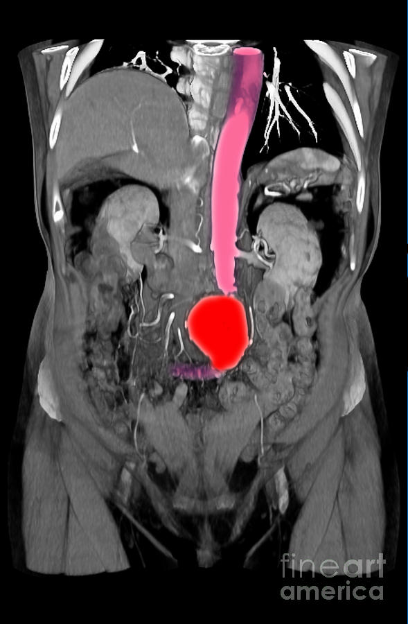Ct Scan Of Abdominal Aortic Aneurysm #6 Photograph by Scott Camazine