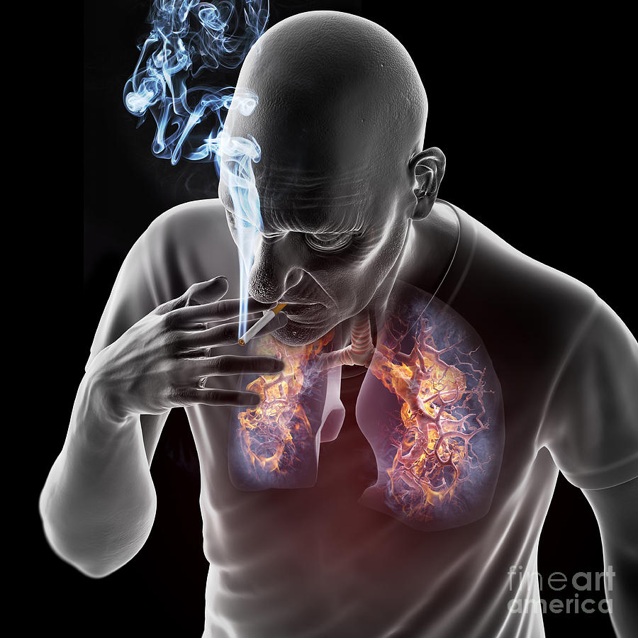Dangers Of Smoking #6 Photograph by Science Picture Co