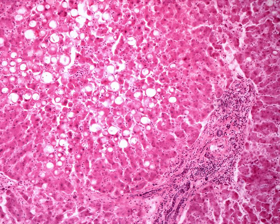 Abnormal Photograph - Fatty Liver #6 by Jose Calvo / Science Photo Library