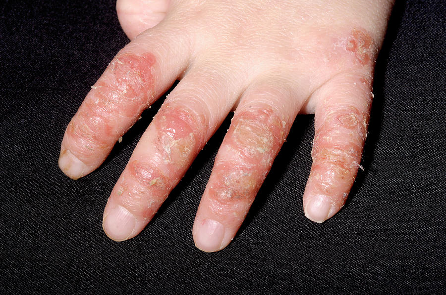 Infected Eczema Photograph By Dr P Marazzi Science Photo Library