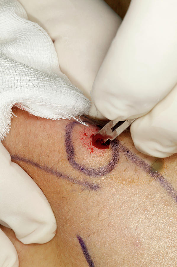 Liposuction Surgery #6 Photograph by Mauro Fermariello/science Photo Library